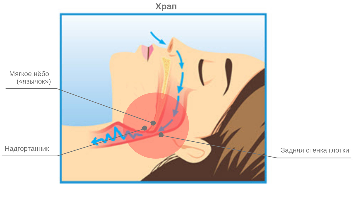 Чтоб не храпеть. Механизм образования храпа. Схема дыхания без храпа.