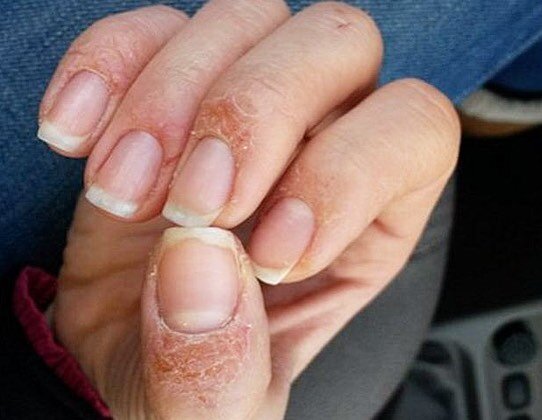 Проявление аллергии на гель-лак