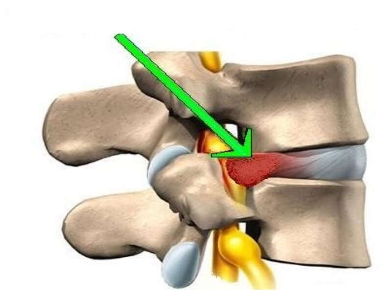 Грыжа позвоночника картинки