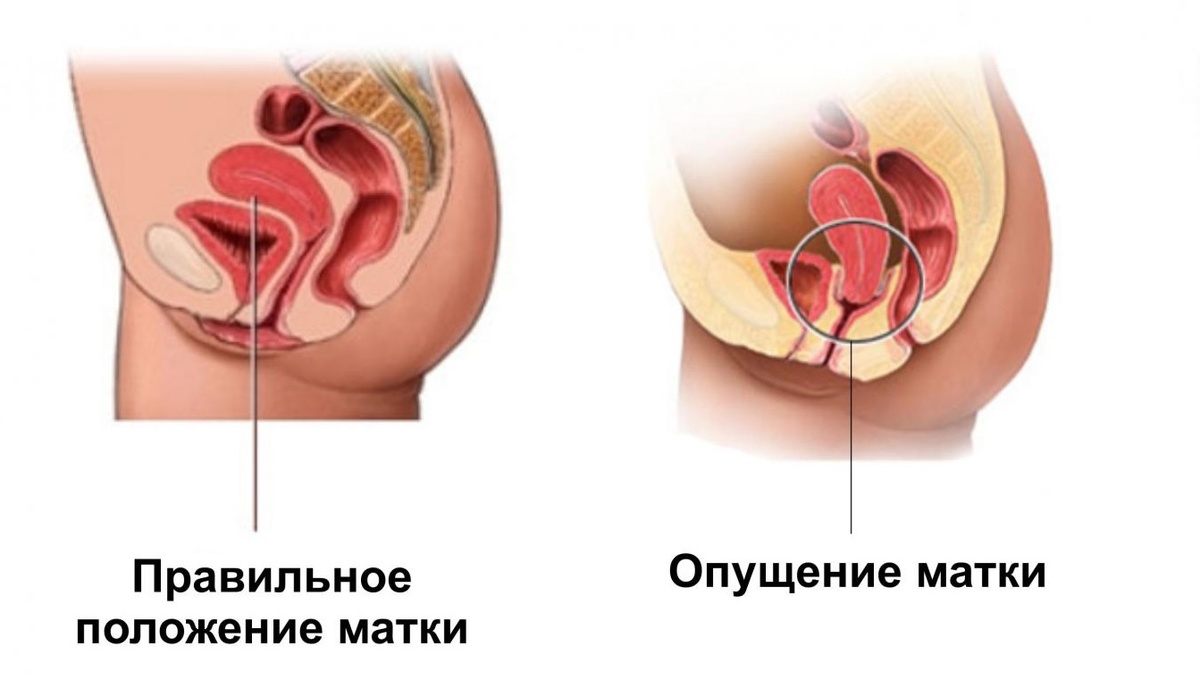 Опущение матки