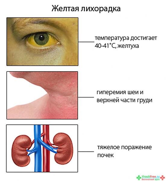 Симптомы жёлтой лихорадки