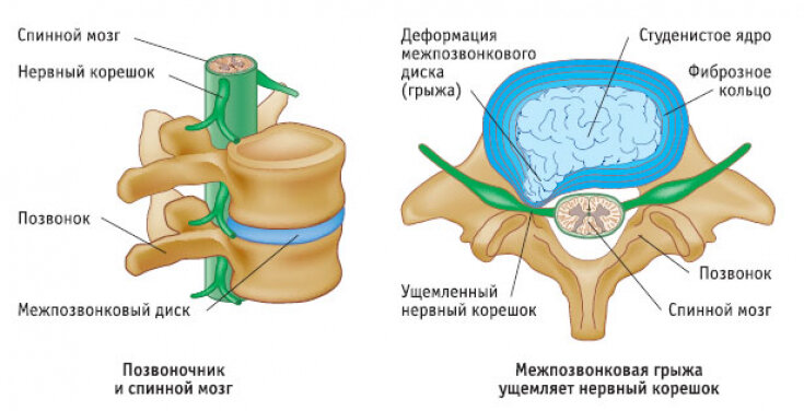 2 упражнения для снятия болей в пояснице, которые можно делать даже при грыже поясничного отдела.