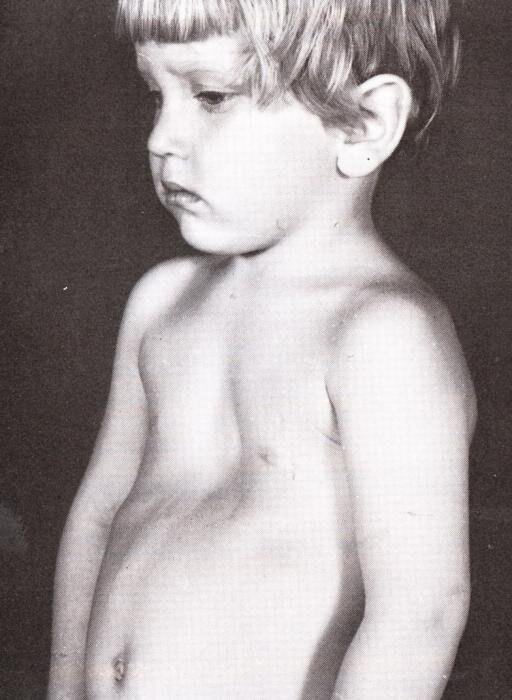 Деформация грудной клетки при рахите