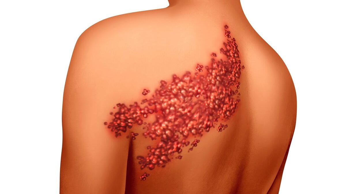 Герпес зостер (схематичное изображение)