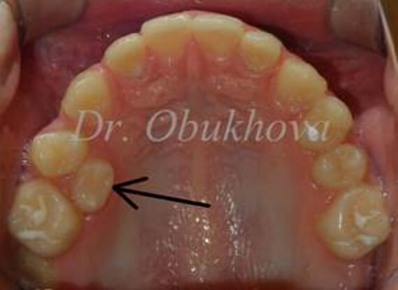 Зуб прорезался вне зубной дуги из-за отсутствия места