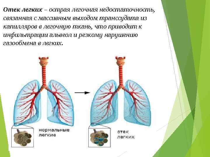 Отек легкого презентация