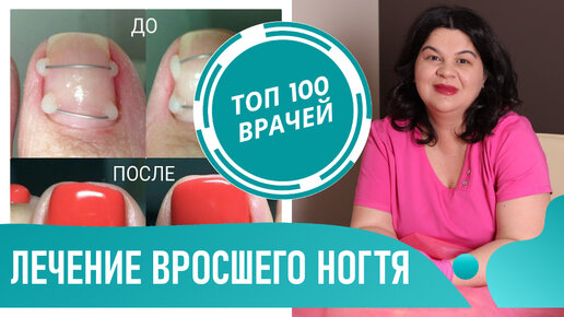 Вросший ноготь на ноге: лечение в домашних условиях, народные средства