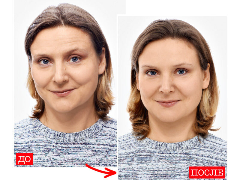 Фото до после ботокса