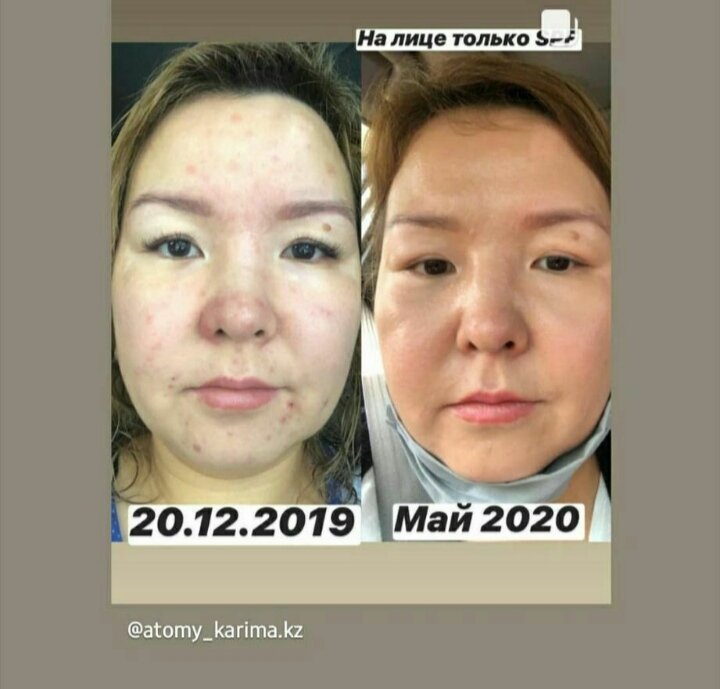 Фото из открытых источников, отзыв Акне Эксперт. 