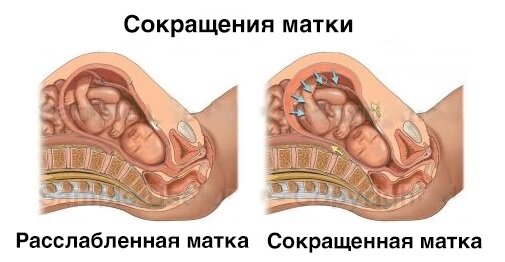 Тонус матки при беременности - Иркутский городской перинатальный центр имени Малиновского М.С.