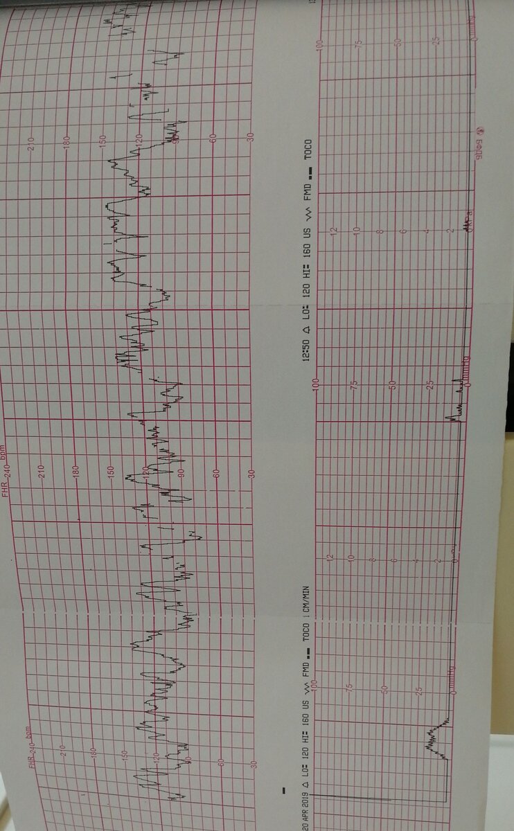 Моё последнее КТГ