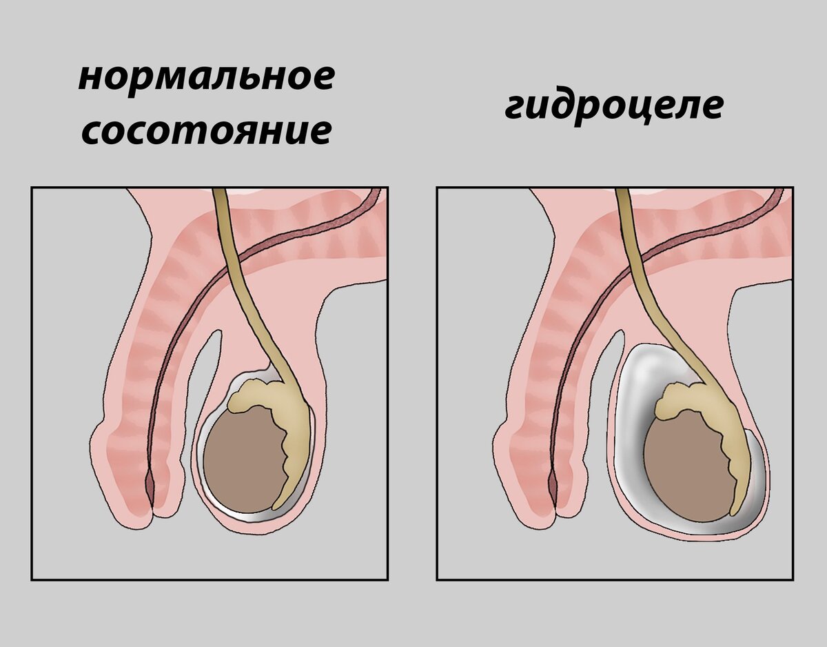 Как мы вылечили ребенку водянку яичка