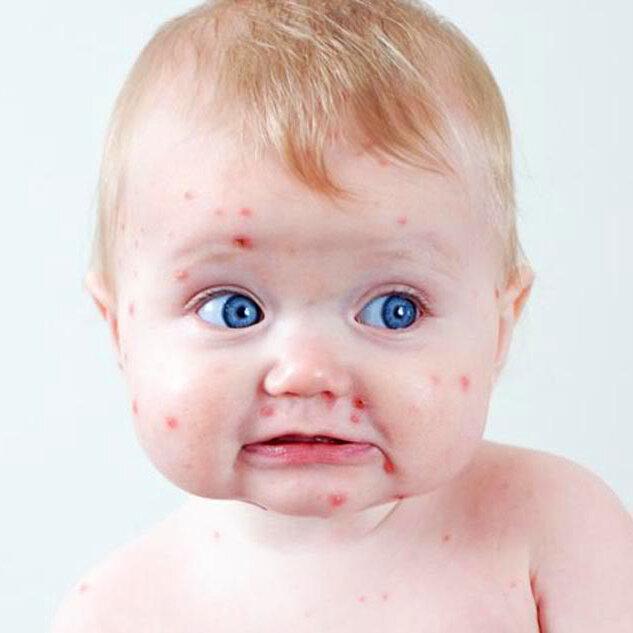 Ветрянка у ребенка