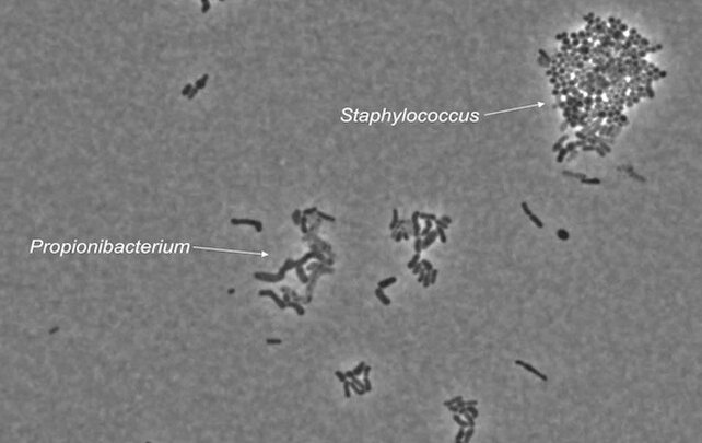 Конкурирующие бактерии Propionibacterium и Staphylococcus под микроскопом.