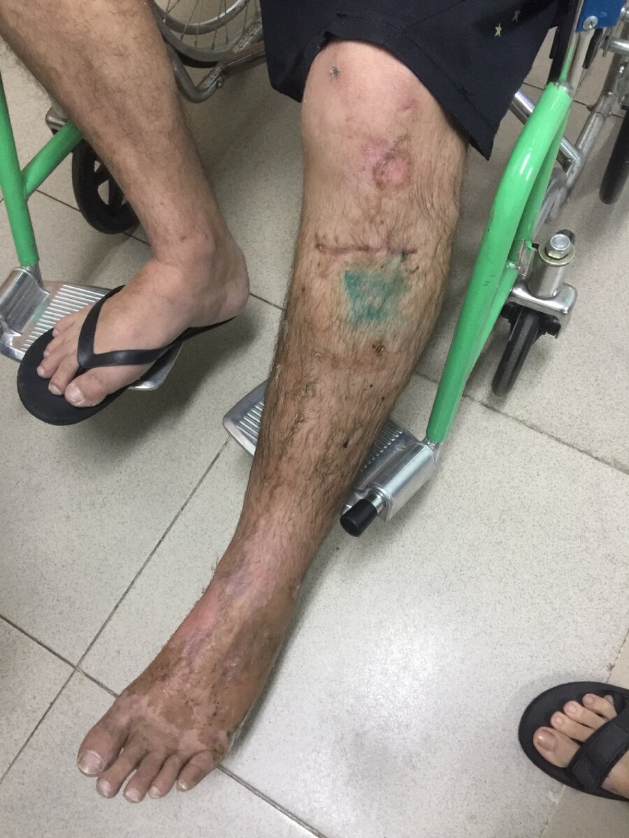 После снятия гипса. Вроде не так страшно.