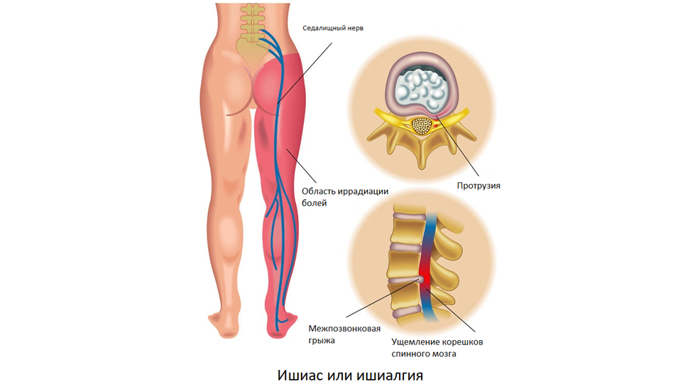 Ишиас клиническая картина