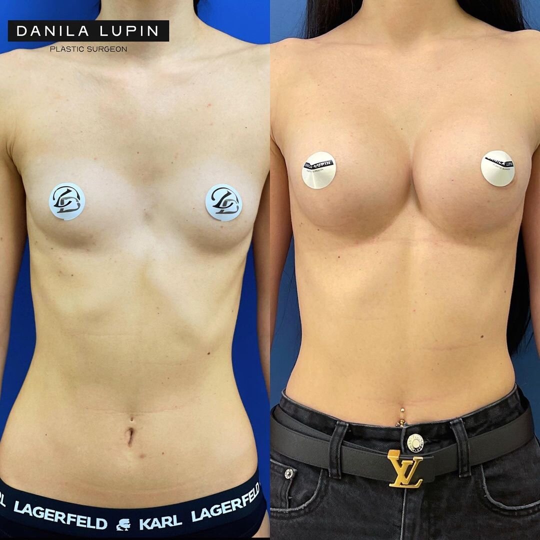 До и после маммопластики. На фото пациентка Данилы Лупина. Имеются противопоказания, необходима консультация специалиста