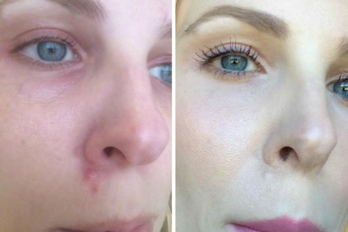 Причин для кожных высыпаний и акне довольно много – это и гормональный фон, и окружающая среда, и хлорированная вода. Помимо этого красные бугорки на самом видном месте могут быть следствием неправильного питания или ухода за лицом (а может быть и вовсе его отсутствия). Курение и алкоголь также пагубно влияют на внешний вид человека, и на состояние эпидермиса, в том числе.