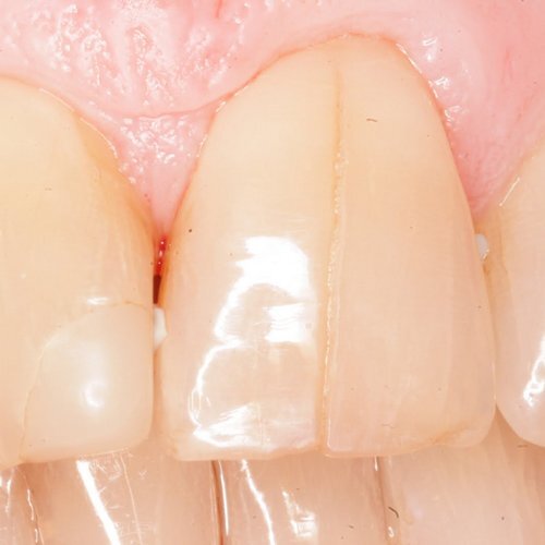 Трещина на зубной эмали