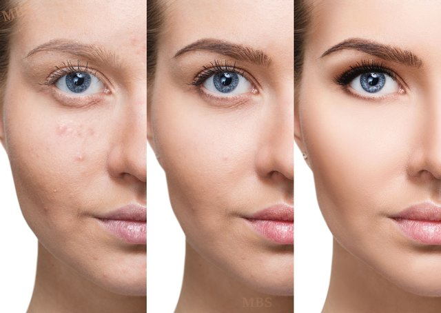Так будет выглядеть лицо после 2-3 сеансов bb-glow, обещают салоны красоты