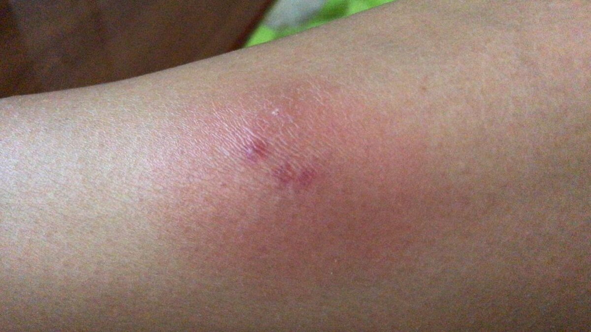 Выдавила гнойник