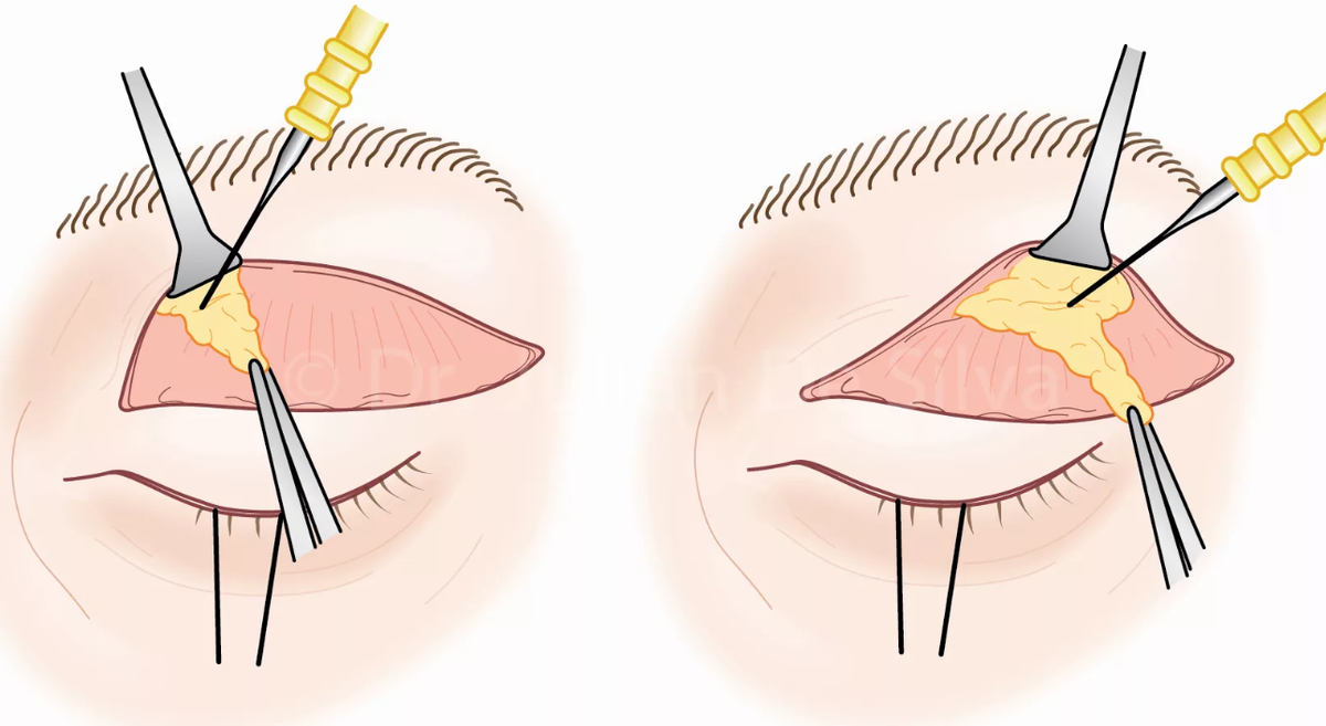 Блефаропластика верхнее веко видео. Блефаропластика верхних век схема. Блефаропластика операция.