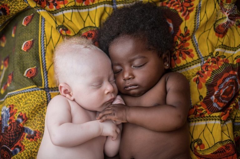 Почему в Африке у темнокожих родителей часто рождаются белые дети и чем это плохо для самих детей