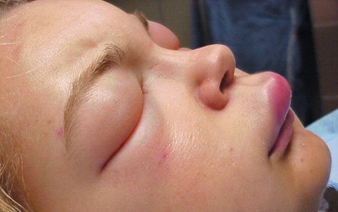 Вот так выглядит отек Квинке, бывает и хуже