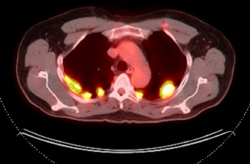 Снимок пораженного легкого, ПЭТ-КТ.