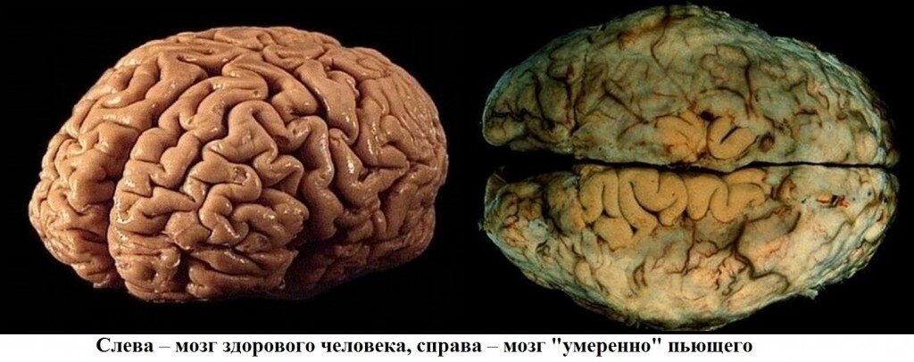Картинка взята из интернета. Она более, чем достоверна, если верить информации, которую могут сообщить клинические психологи (афазии, агнозии, делирии, которые обнаруживаются при органических повреждениях мозга). Мозг пьяного человека работает не так, как у трезвого. Попробуйте ответить на вопрос, с каким человеком возможно договориться о том, как выйти из кризисной ситуации? с тем, что слева или с тем, что справа? Если ответ очевиден, то почему у нас в магазине алкоголя так много? и почему у нас в магазине есть "только" алкоголь?