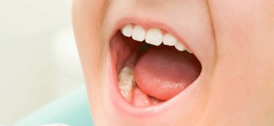 Нормальное состояние слизистой оболочки полости рта у детей