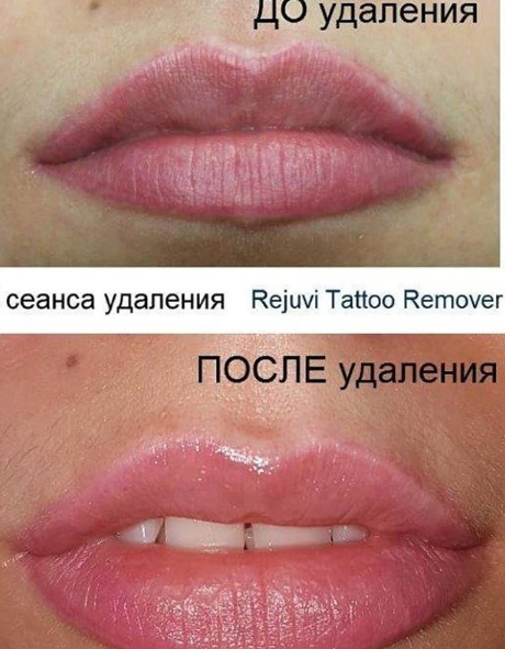 Удаление перманентного макияжа губ