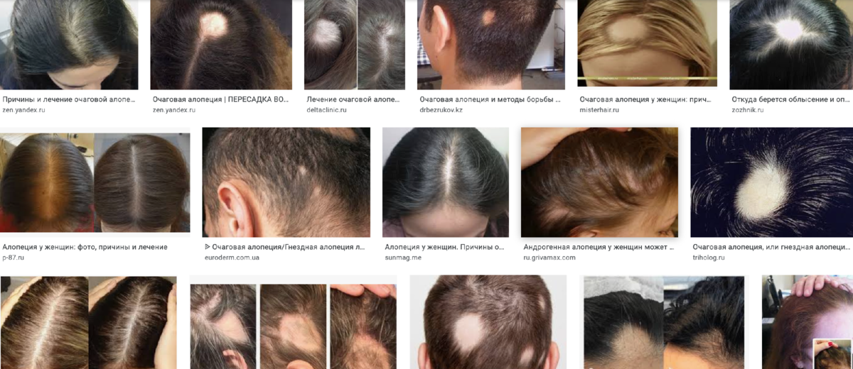 Очаговая алопеция офиазис. Как лечить очаговую алопецию. Гнёздная (очаговая алопеция). Как лечить очаговую алопецию. Диффузная гнездная алопеция.