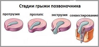 Стадии развития болезни