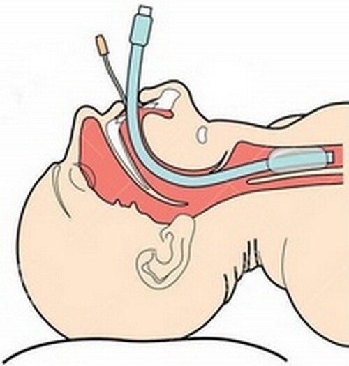 Метод эндотрахеального наркоза. Ларингеальная маска для интубации. Трубка в горло во время операции. Трубка в горло во время операции. Интубация трахеи эндотрахеальной трубкой.