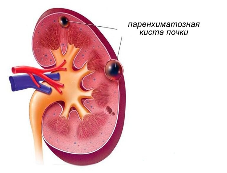 Образование паренхимы. Паренхиматозная киста почки. Интрапаренхиматозная киста почки. Симптомы паренхиматозная киста почки.