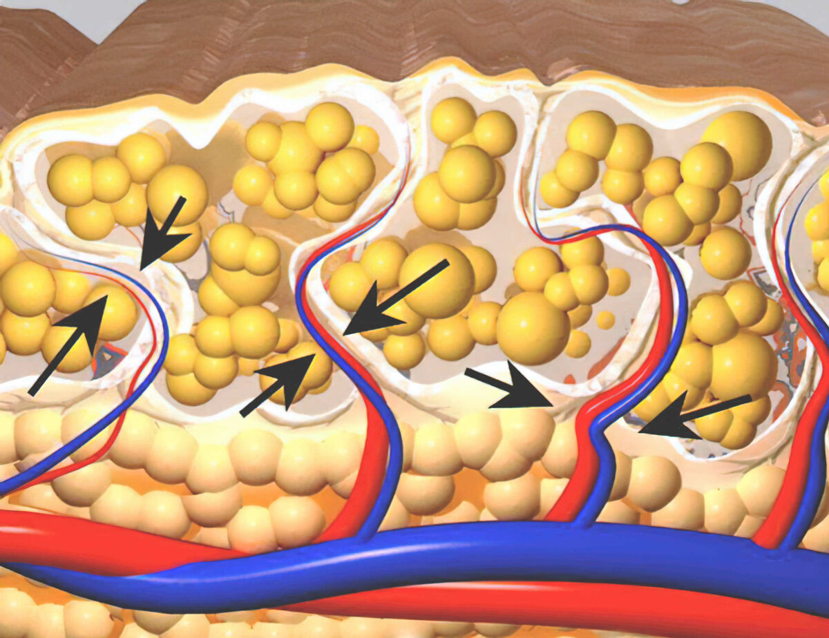 Жировая конверсия. Целлюлит подкожный жир. Жировая прослойка кожи.