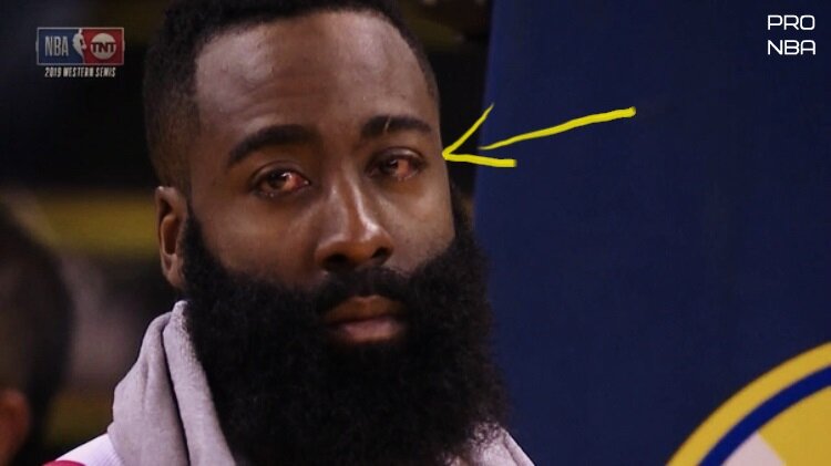 Травмированный глаз Джеймса Хардена