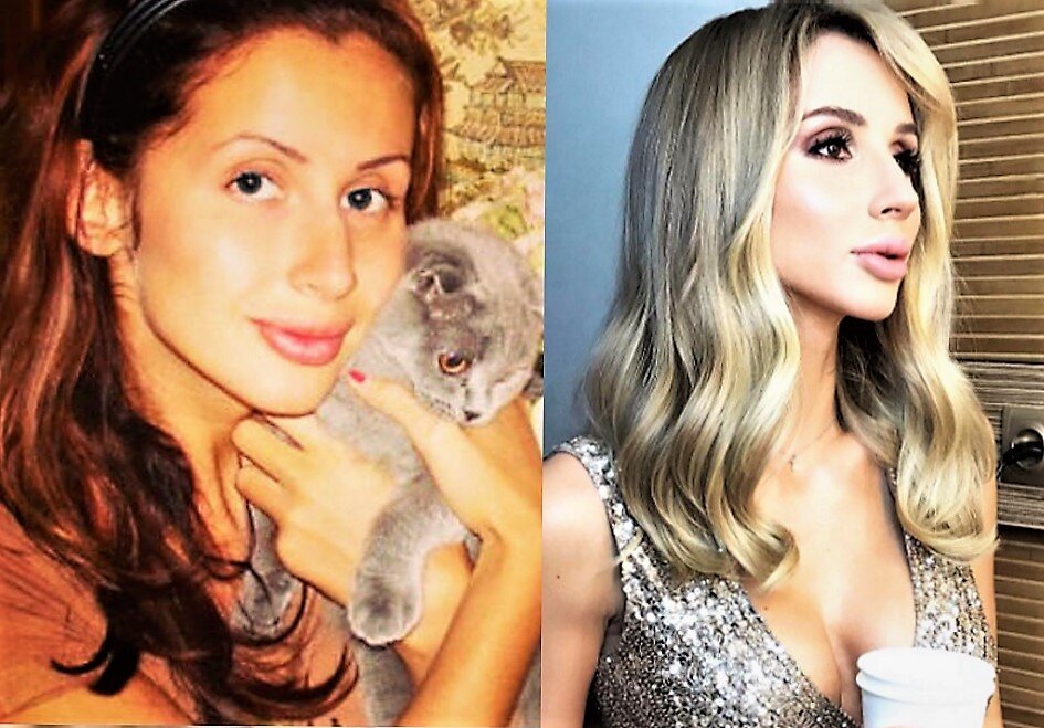 Лобода до и после пластических операций