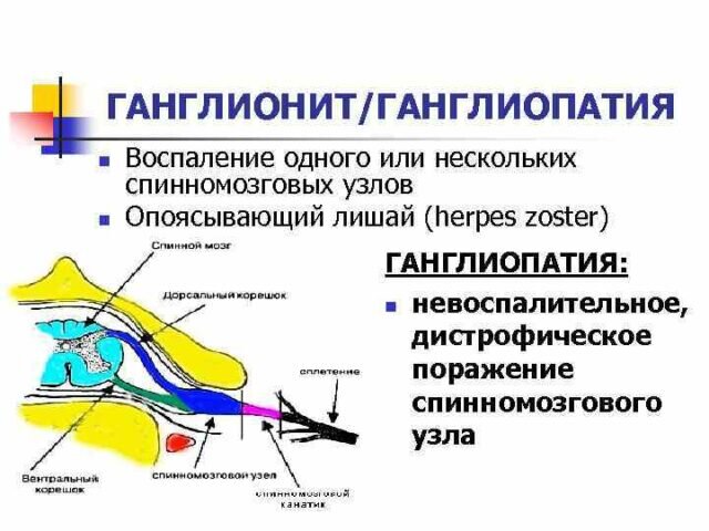 Липома (жировик)