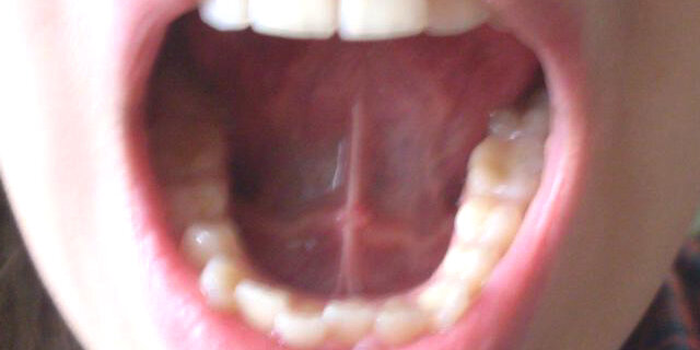 Пластика уздечки верхней губы — Сеть МЦ «Доктор Боголюбов»