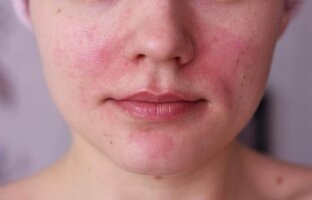 Причины покраснения кожи лица