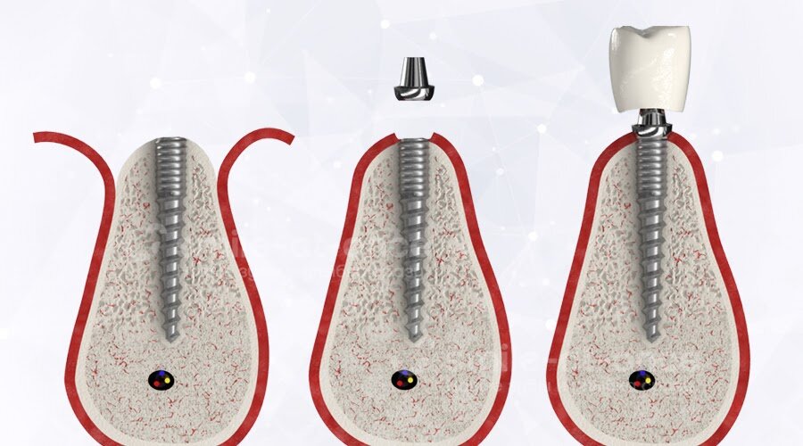 При двухэтапной имплантации установка импланта в кость и фиксация коронки разнесены по времени – в среднем между ними проходит 3-6 месяцев. Фото: Smile-at-Once.ru.