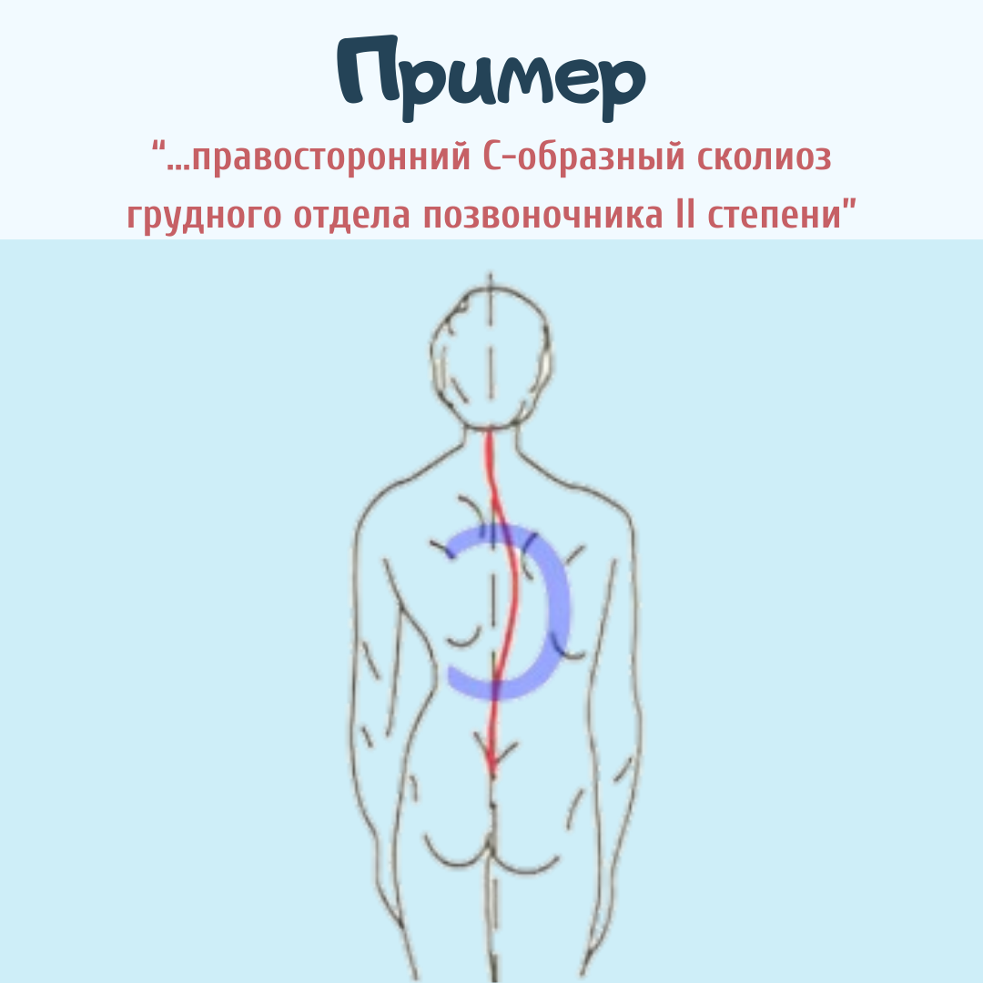 Правосторонний сколиоз грудного отдела позвоночника 1 степени. S образный сколиоз. Правосторонний с-образный сколиоз грудного отдела позвоночника. С-образный сколиоз 1 степени. С образный и s образный сколиоз.