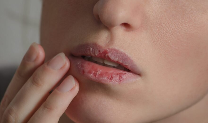 Что делать, если потрескались губы: лечение и профилактика
