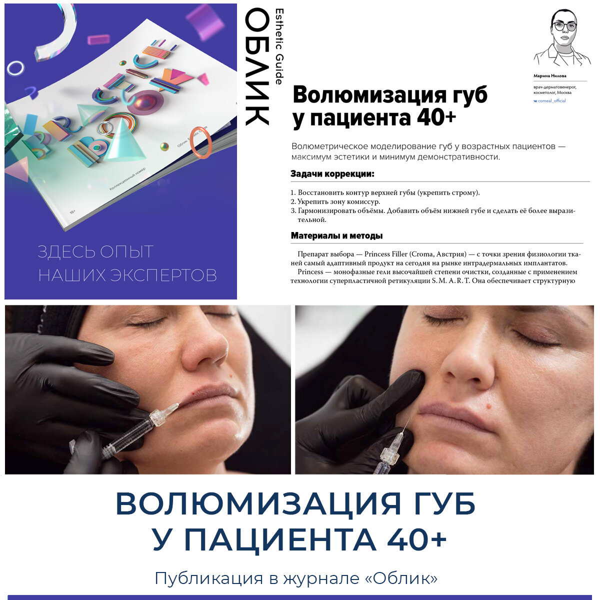 Волюмизация губ у пациента 40+ | Corneal Official | Дзен