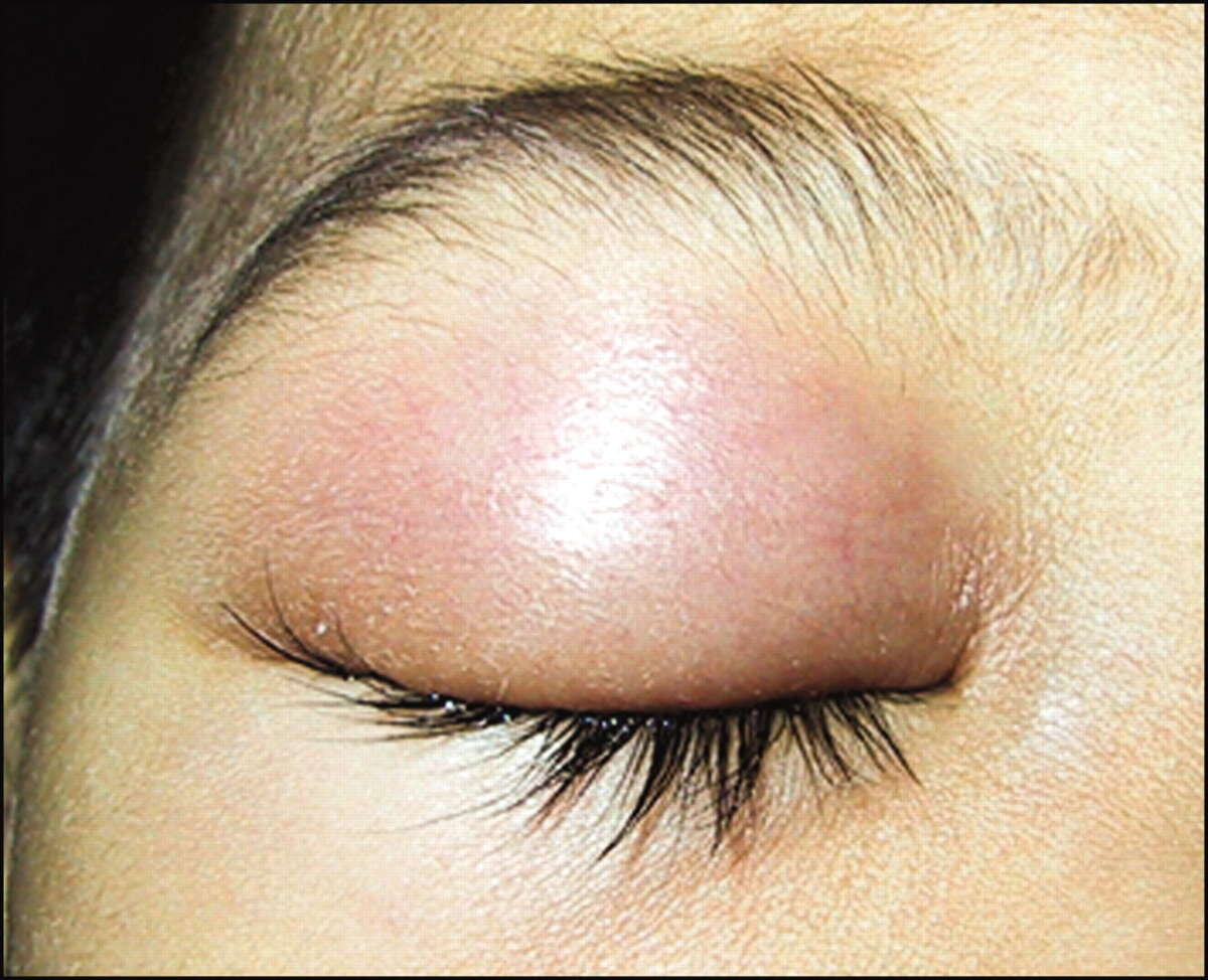 Очень часто, после укуса пчелы в лицо, человек "слепнет" на один или оба глаза на пару дней.../Фото из открытых источников