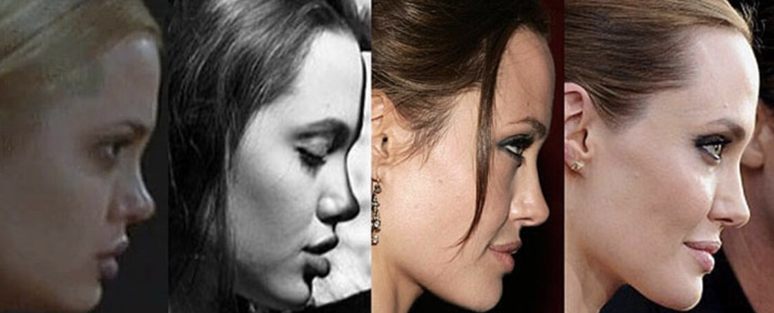 Углы джоли на круглое лицо фото до и после