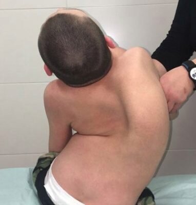 Искривление позвоночника. 