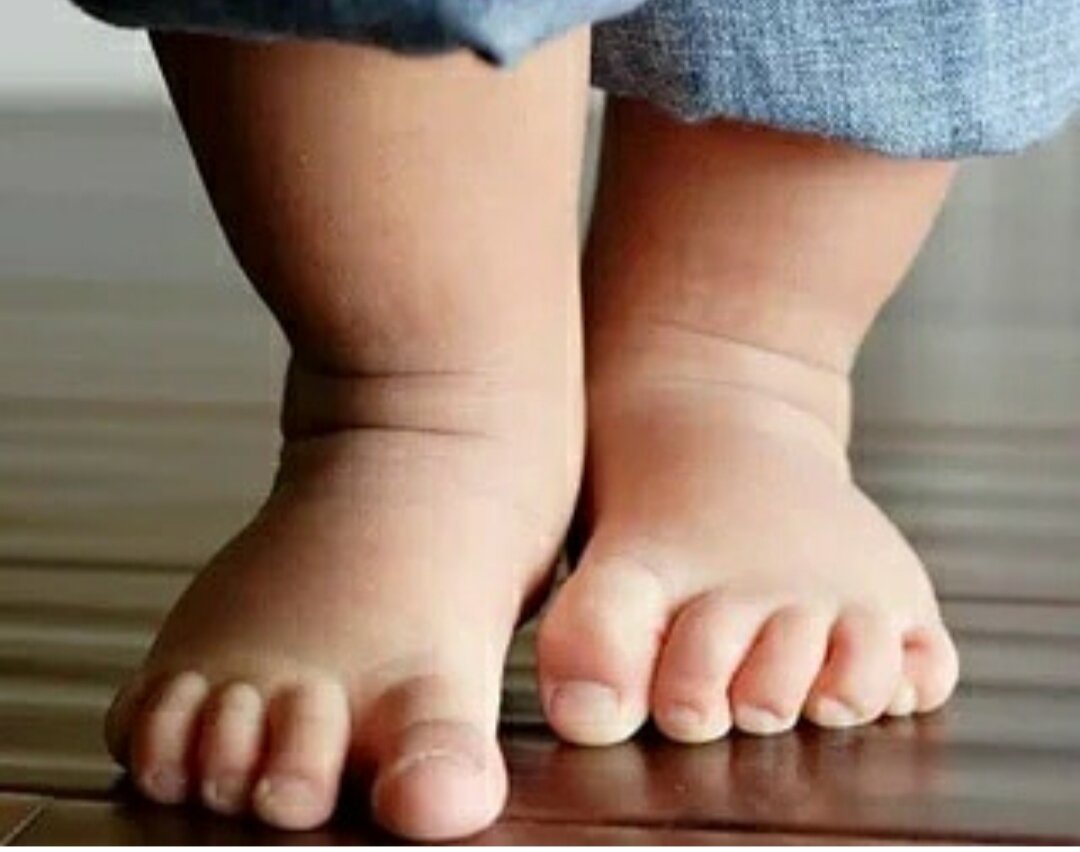 Поджатие пальцев при вертикализации ребенка